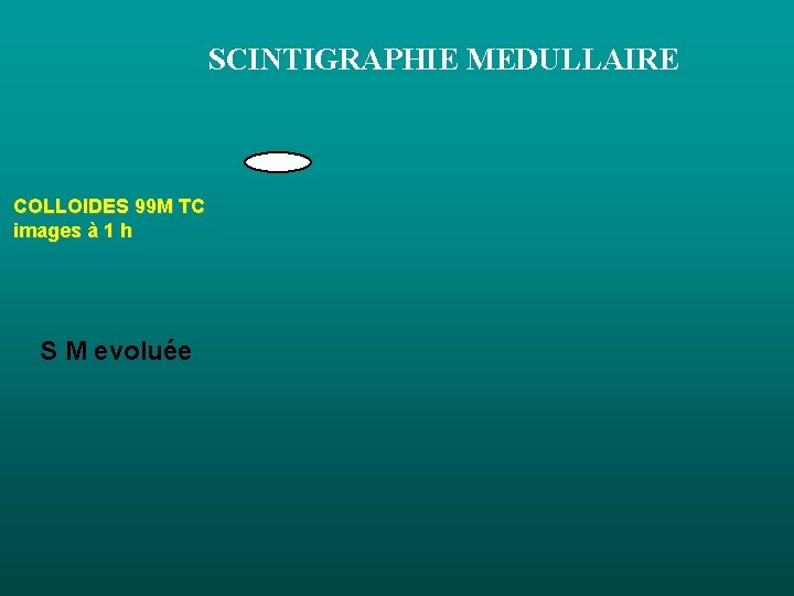 SCINTIGRAPHIE MEDULLAIRE COLLOIDES 99 M TC images à 1 h S M evoluée SCINTIGRAPHIE MEDULLAIRE COLLOIDES 99 M TC images à 1 h S M evoluée