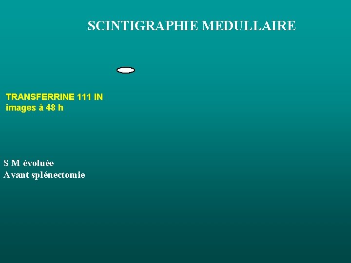 SCINTIGRAPHIE MEDULLAIRE TRANSFERRINE 111 IN images à 48 h S M évoluée Avant splénectomie SCINTIGRAPHIE MEDULLAIRE TRANSFERRINE 111 IN images à 48 h S M évoluée Avant splénectomie