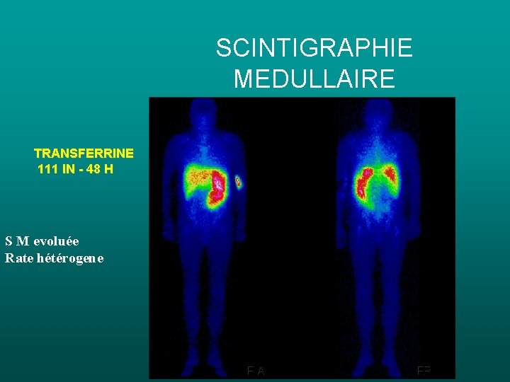SCINTIGRAPHIE MEDULLAIRE TRANSFERRINE 111 IN - 48 H S M evoluée Rate hétérogene FA SCINTIGRAPHIE MEDULLAIRE TRANSFERRINE 111 IN - 48 H S M evoluée Rate hétérogene FA