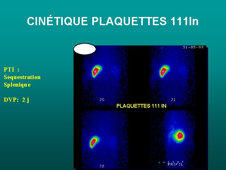 CINÉTIQUE PLAQUETTES 111 In PTI : Sequestration Splenique DVP: 2 j PLAQUETTES 111 IN CINÉTIQUE PLAQUETTES 111 In PTI : Sequestration Splenique DVP: 2 j PLAQUETTES 111 IN