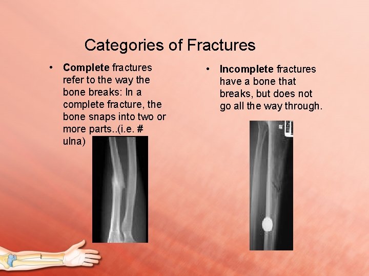 FRACTURES And other Orthopaedic Disorders Jill Cavaiuolo Fracture