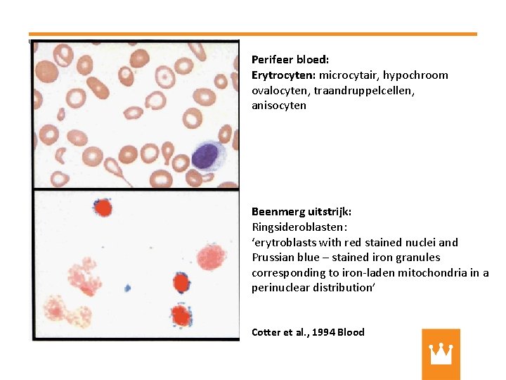Perifeer bloed: Erytrocyten: microcytair, hypochroom ovalocyten, traandruppelcellen, anisocyten Beenmerg uitstrijk: Ringsideroblasten: ‘erytroblasts with red