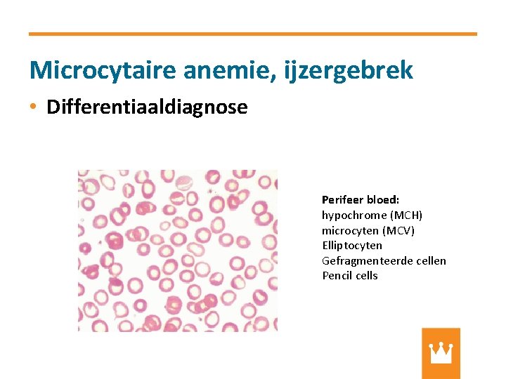 Microcytaire anemie, ijzergebrek • Differentiaaldiagnose Perifeer bloed: hypochrome (MCH) microcyten (MCV) Elliptocyten Gefragmenteerde cellen