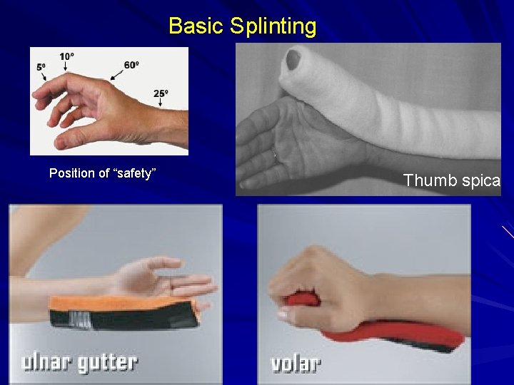 Basic Splinting Position of “safety” Thumb spica 