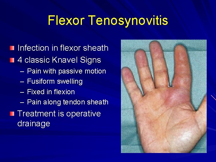 Flexor Tenosynovitis Infection in flexor sheath 4 classic Knavel Signs – – Pain with