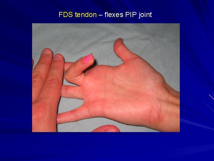 FDS tendon – flexes PIP joint 
