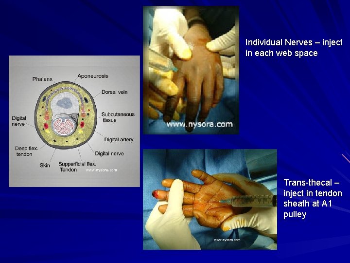 Individual Nerves – inject in each web space Trans-thecal – inject in tendon sheath