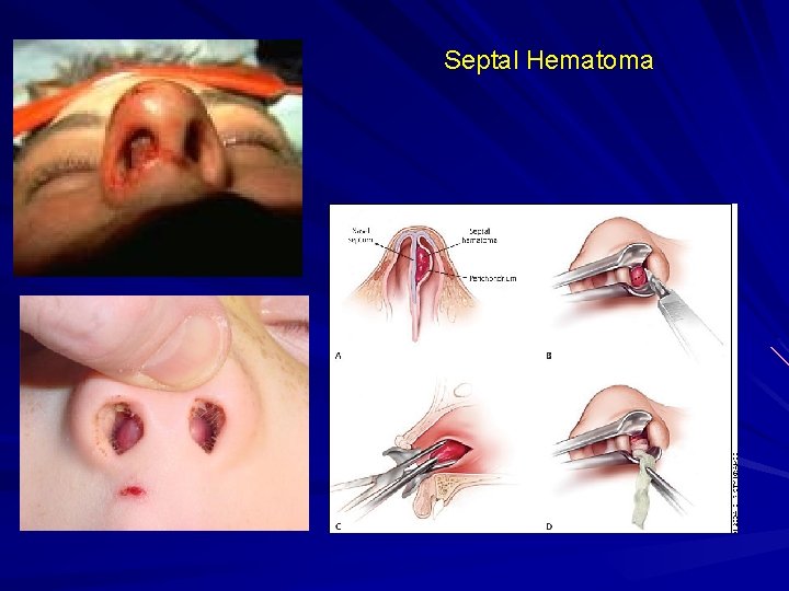 Septal Hematoma 
