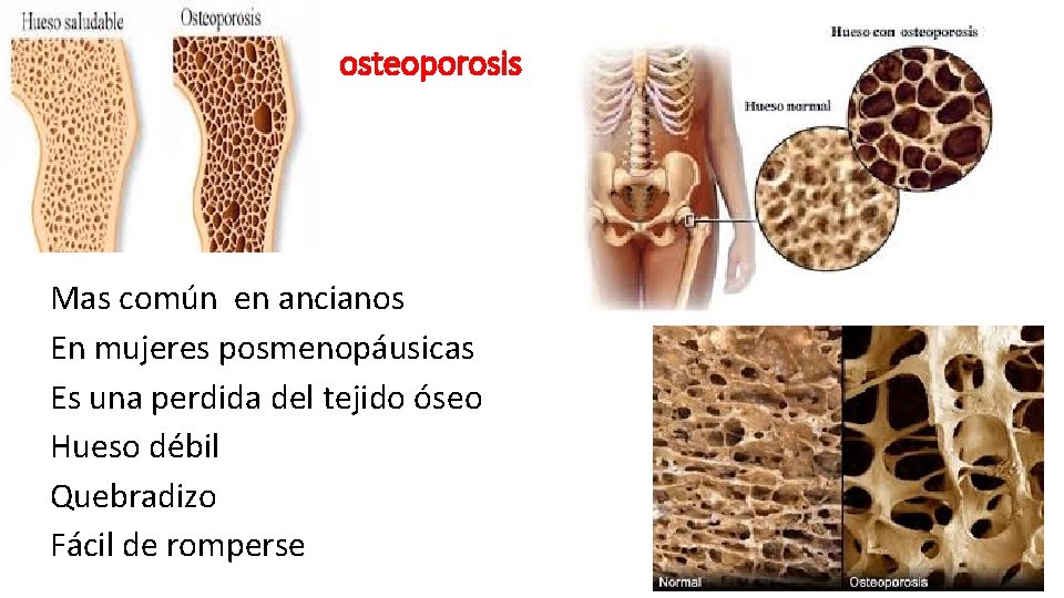 osteoporosis Mas común en ancianos En mujeres posmenopáusicas Es una perdida del tejido óseo