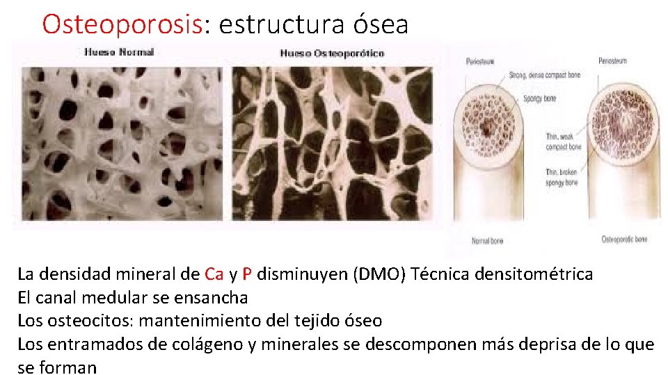 Osteoporosis: estructura ósea La densidad mineral de Ca y P disminuyen (DMO) Técnica densitométrica