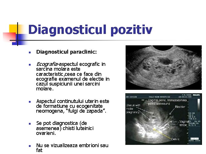 Diagnosticul pozitiv n Diagnosticul paraclinic: n Ecografia-aspectul ecografic in n sarcina molara este caracteristic,