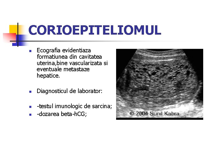 CORIOEPITELIOMUL n n Ecografia evidentiaza formatiunea din cavitatea uterina, bine vascularizata si eventuale metastaze