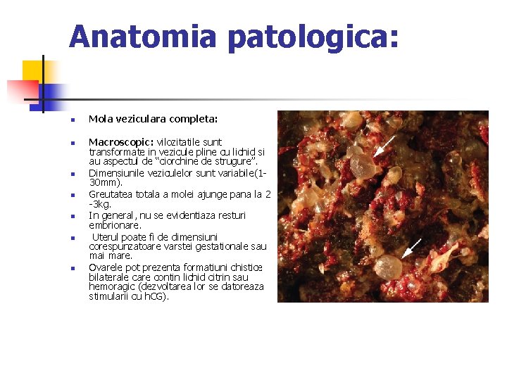 Anatomia patologica: n n n n Mola veziculara completa: Macroscopic: vilozitatile sunt transformate in