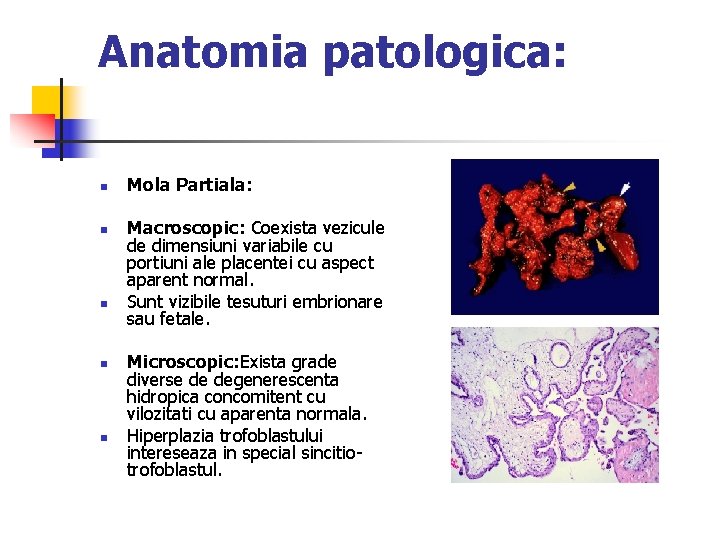 Anatomia patologica: n n n Mola Partiala: Macroscopic: Coexista vezicule de dimensiuni variabile cu