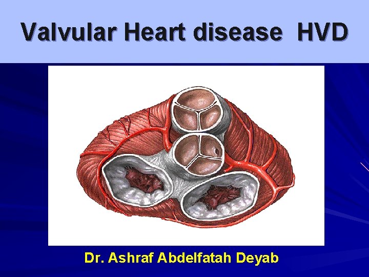 Valvular Heart disease HVD By Dr. Ashraf Abdelfatah Deyab 