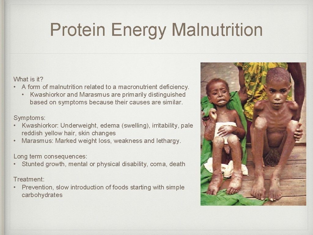 Protein Energy Malnutrition What is it? • A form of malnutrition related to a Protein Energy Malnutrition What is it? • A form of malnutrition related to a