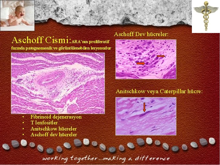Aschoff Cismi: ARA’nın proliferatif Aschoff Dev hücreler: fazında patognomonik ve görüntülenebilen lezyonudur Anitschkow veya Aschoff Cismi: ARA’nın proliferatif Aschoff Dev hücreler: fazında patognomonik ve görüntülenebilen lezyonudur Anitschkow veya