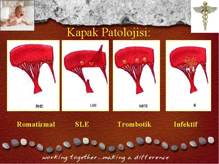 Kapak Patolojisi: Romatizmal SLE Trombotik Infektif Kapak Patolojisi: Romatizmal SLE Trombotik Infektif