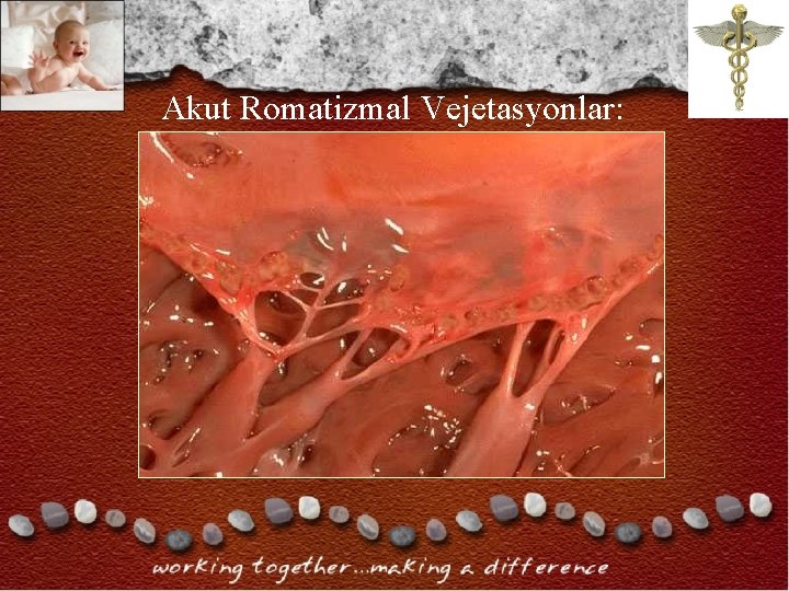 Akut Romatizmal Vejetasyonlar: Akut Romatizmal Vejetasyonlar:
