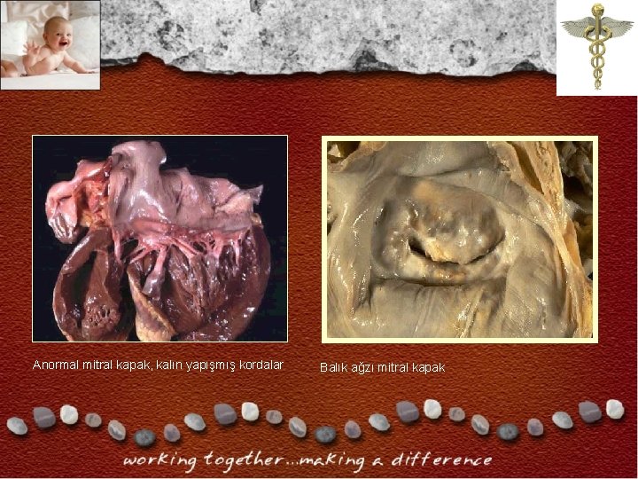 Anormal mitral kapak, kalın yapışmış kordalar Balık ağzı mitral kapak Anormal mitral kapak, kalın yapışmış kordalar Balık ağzı mitral kapak