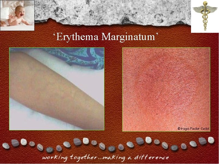 ‘Erythema Marginatum’ ‘Erythema Marginatum’