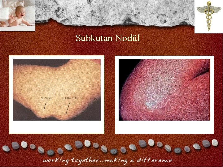 Subkutan Nodül Subkutan Nodül