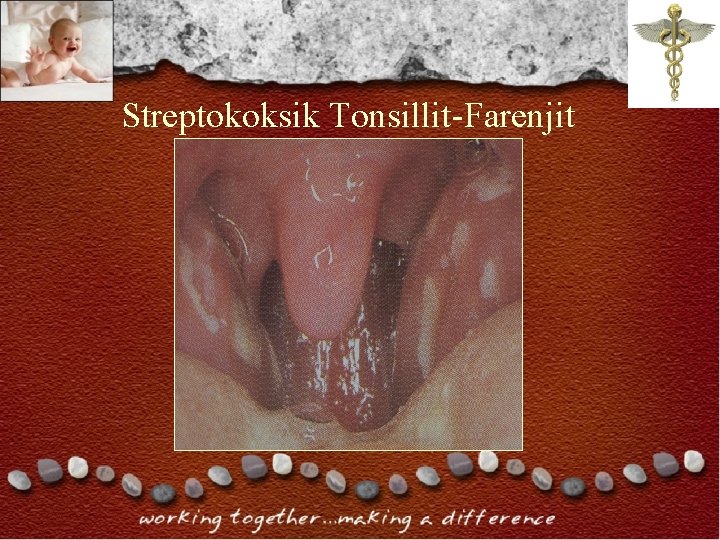 Streptokoksik Tonsillit-Farenjit Streptokoksik Tonsillit-Farenjit
