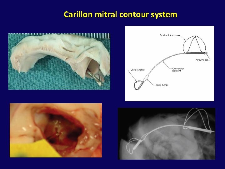 Carillon mitral contour system 