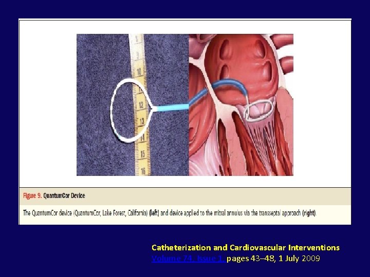Catheterization and Cardiovascular Interventions Volume 74, Issue 1, pages 43– 48, 1 July 2009