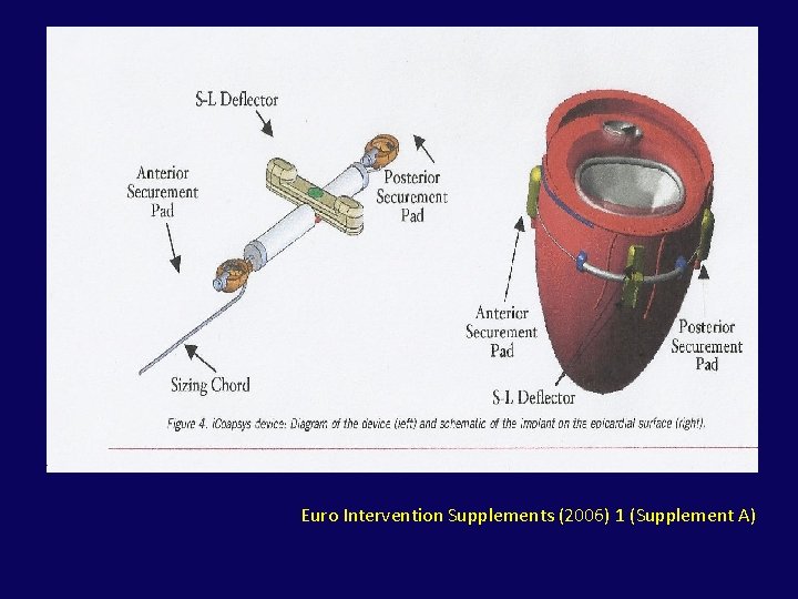 Euro Intervention Supplements (2006) 1 (Supplement A) 