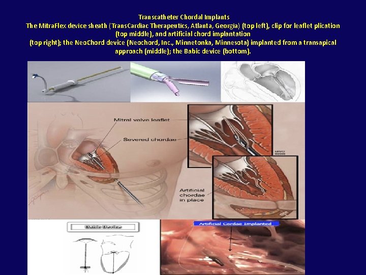 Transcatheter Chordal Implants The Mitra. Flex device sheath (Trans. Cardiac Therapeutics, Atlanta, Georgia) (top