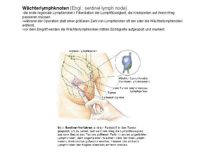 Wächterlymphknoten (Engl. : sentinel lymph node). -die erste regionale Lymphknoten / Filterstation der Lymphflüssigkeit,