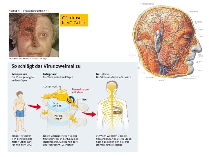 Gürtelrose In V/1 Gebiet 