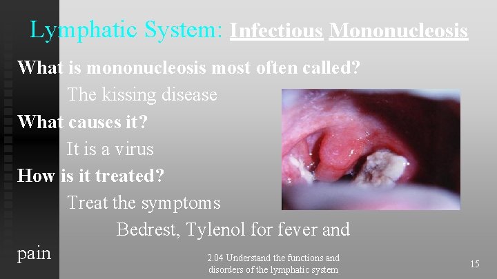 Lymphatic System: Infectious Mononucleosis What is mononucleosis most often called? The kissing disease What Lymphatic System: Infectious Mononucleosis What is mononucleosis most often called? The kissing disease What
