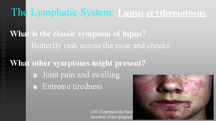 The Lymphatic System: Lupus erythematosus What is the classic symptom of lupus? Butterfly rash The Lymphatic System: Lupus erythematosus What is the classic symptom of lupus? Butterfly rash