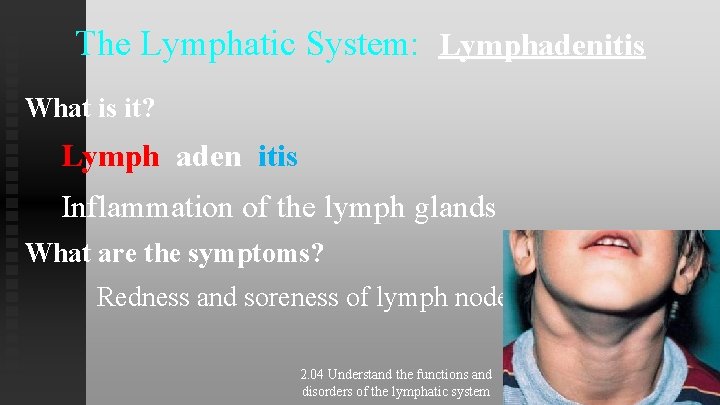 The Lymphatic System: Lymphadenitis What is it? Lymph aden itis Inflammation of the lymph The Lymphatic System: Lymphadenitis What is it? Lymph aden itis Inflammation of the lymph