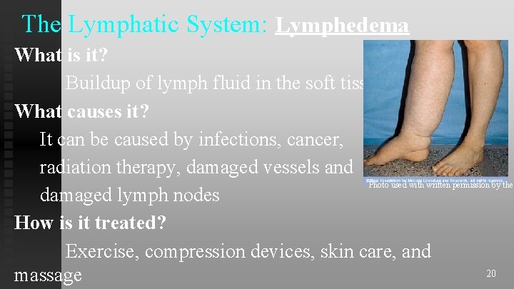 The Lymphatic System: Lymphedema What is it? Buildup of lymph fluid in the soft The Lymphatic System: Lymphedema What is it? Buildup of lymph fluid in the soft