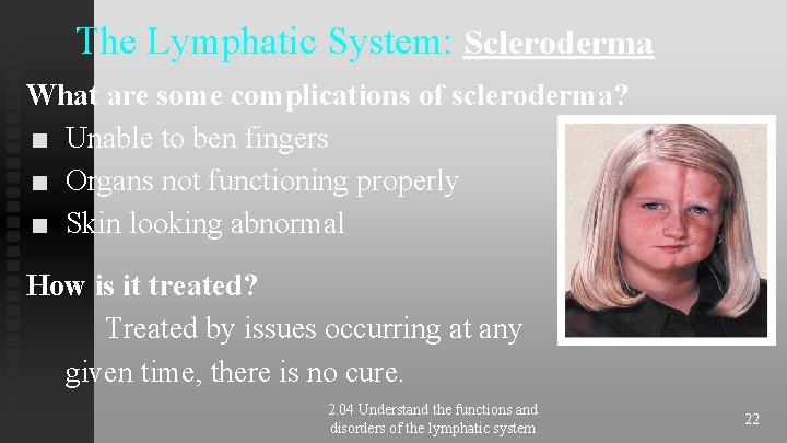 The Lymphatic System: Scleroderma What are some complications of scleroderma? ■ Unable to ben The Lymphatic System: Scleroderma What are some complications of scleroderma? ■ Unable to ben