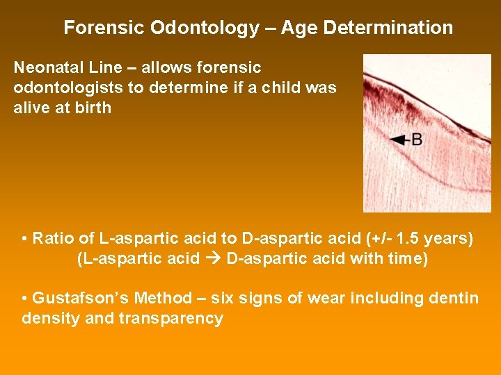 Forensic Odontology – Age Determination Neonatal Line – allows forensic odontologists to determine if