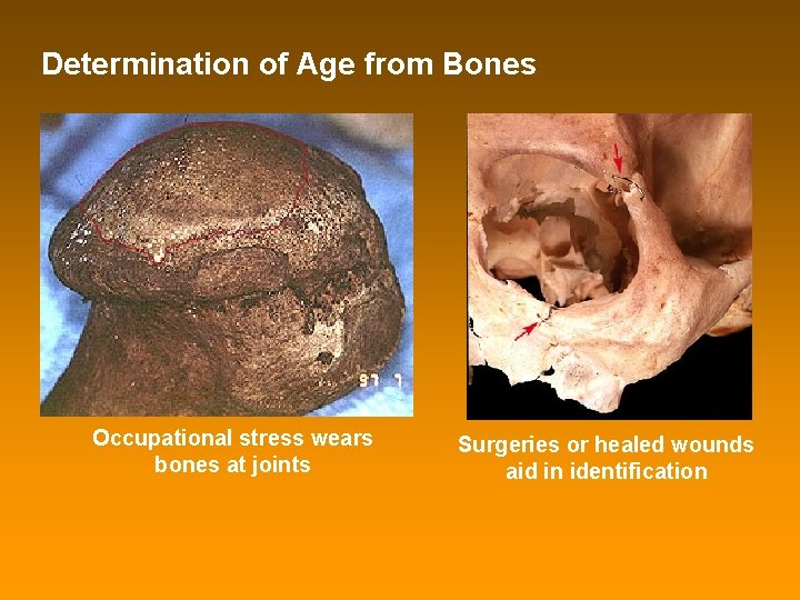 Determination of Age from Bones Occupational stress wears bones at joints Surgeries or healed