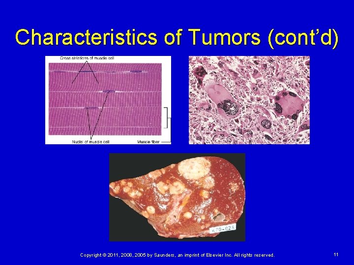 Characteristics of Tumors (cont’d) Copyright © 2011, 2008, 2005 by Saunders, an imprint of