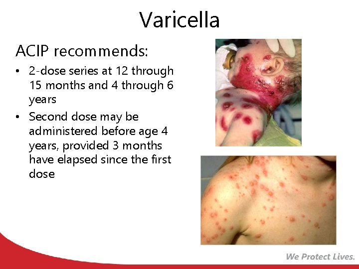 Varicella ACIP recommends: • 2 -dose series at 12 through 15 months and 4