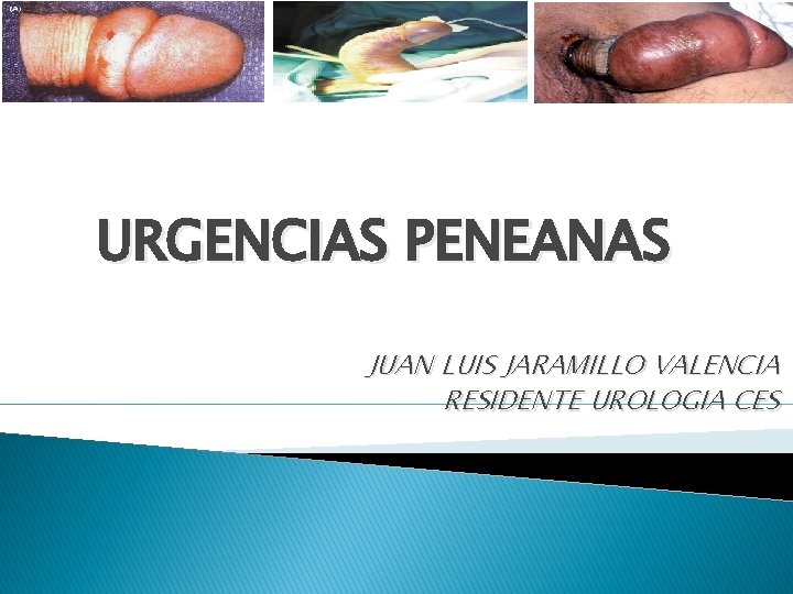 URGENCIAS PENEANAS JUAN LUIS JARAMILLO VALENCIA RESIDENTE UROLOGIA CES URGENCIAS PENEANAS JUAN LUIS JARAMILLO VALENCIA RESIDENTE UROLOGIA CES