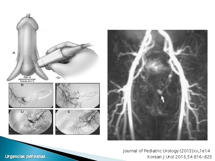 Urgencias peneanas Journal of Pediatric Urology (2013)xx, 1 e 14 Korean J Urol 2013; Urgencias peneanas Journal of Pediatric Urology (2013)xx, 1 e 14 Korean J Urol 2013;