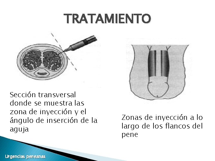 TRATAMIENTO Sección transversal donde se muestra las zona de inyección y el ángulo de TRATAMIENTO Sección transversal donde se muestra las zona de inyección y el ángulo de