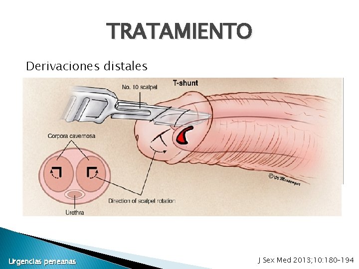 TRATAMIENTO Derivaciones distales Urgencias peneanas J Sex Med 2013; 10: 180– 194 TRATAMIENTO Derivaciones distales Urgencias peneanas J Sex Med 2013; 10: 180– 194