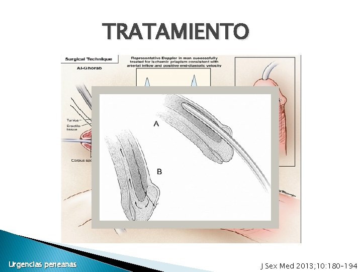 TRATAMIENTO Urgencias peneanas J Sex Med 2013; 10: 180– 194 TRATAMIENTO Urgencias peneanas J Sex Med 2013; 10: 180– 194
