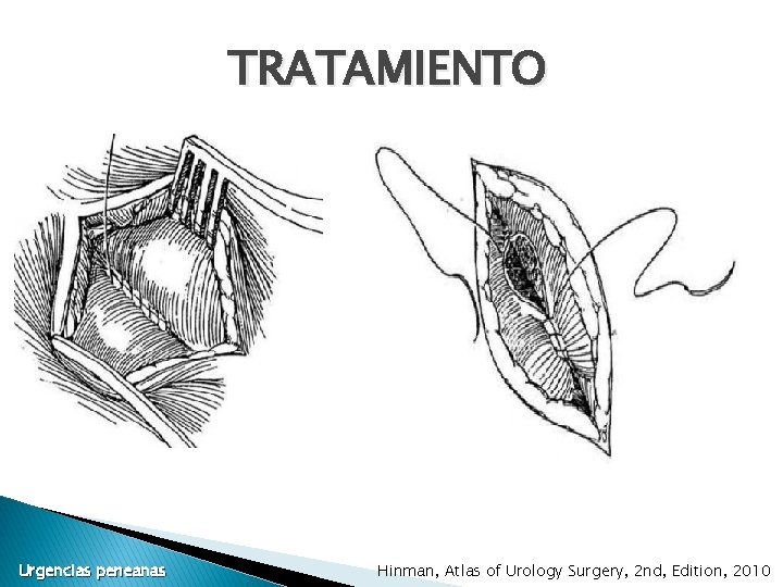 TRATAMIENTO Urgencias peneanas Hinman, Atlas of Urology Surgery, 2 nd, Edition, 2010 TRATAMIENTO Urgencias peneanas Hinman, Atlas of Urology Surgery, 2 nd, Edition, 2010
