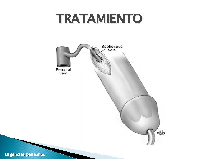 TRATAMIENTO Urgencias peneanas TRATAMIENTO Urgencias peneanas