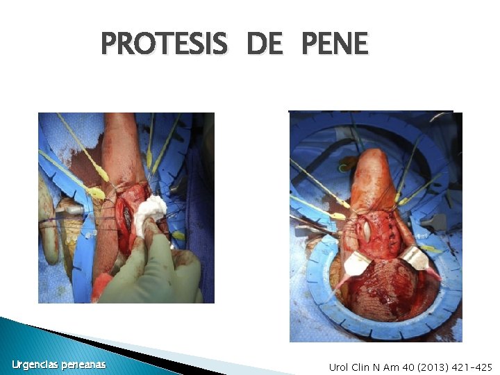 PROTESIS DE PENE Urgencias peneanas Urol Clin N Am 40 (2013) 421– 425 PROTESIS DE PENE Urgencias peneanas Urol Clin N Am 40 (2013) 421– 425